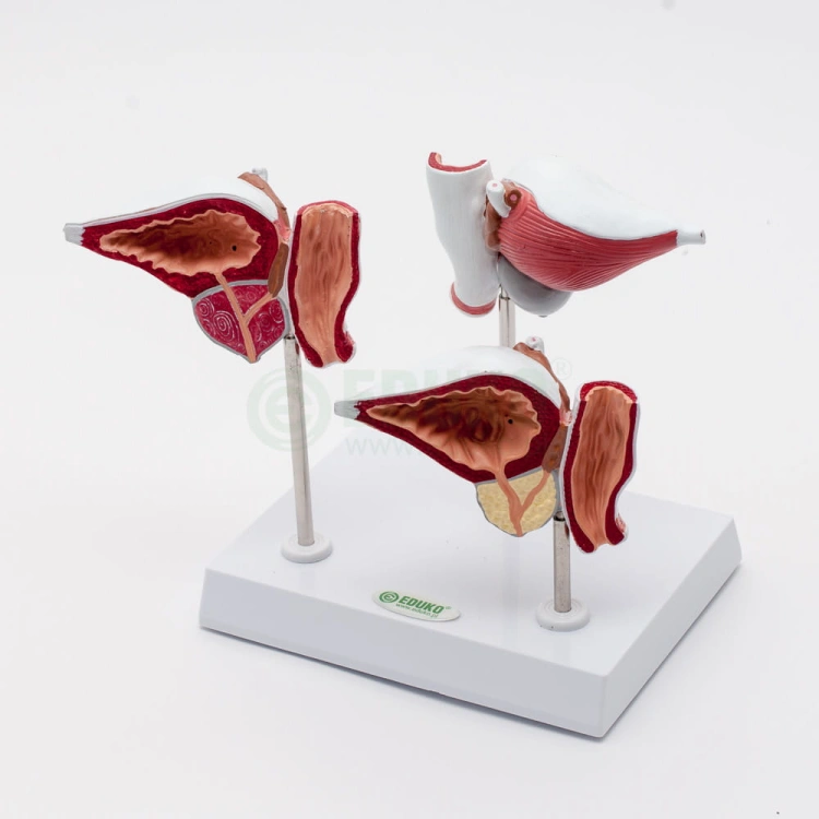 Model prostaty - zmiany patologiczne